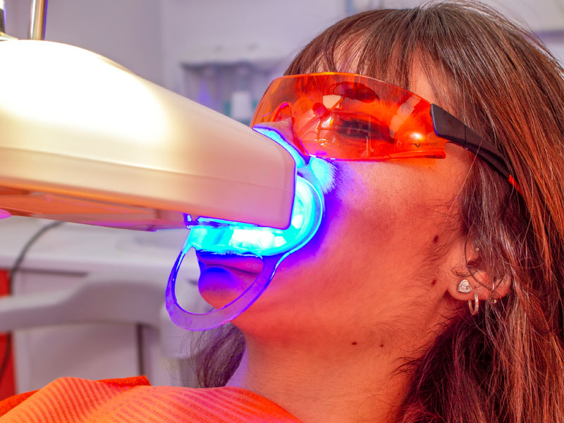 precio de blanqueamiento dental barato en clínica de Fuenlabrada Madrid
